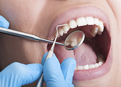 Test de ciment pour prothèses dentaires